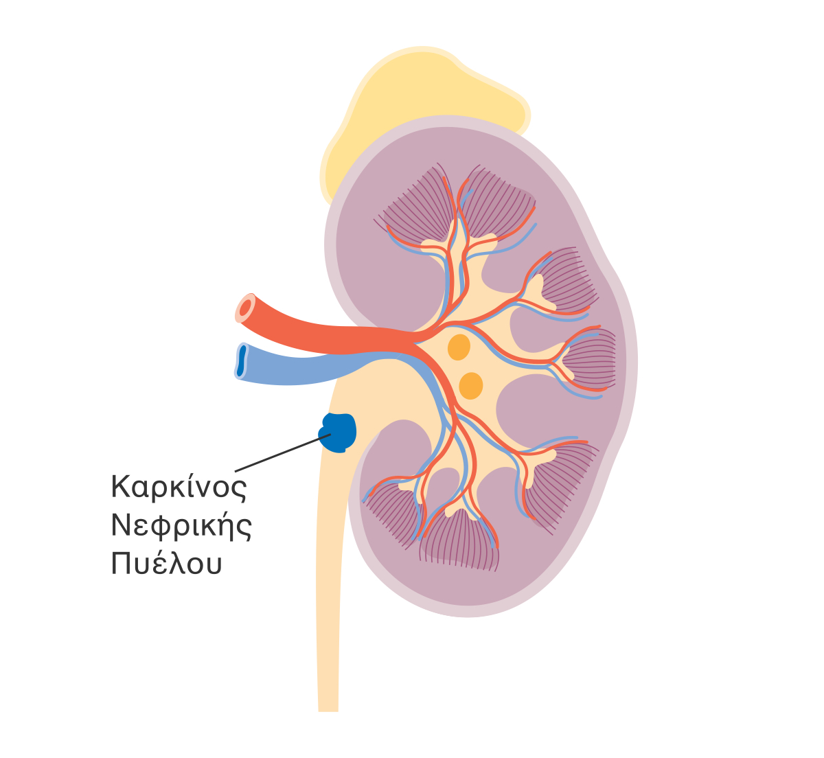 Καρκίνος Νεφρικής Πυέλου