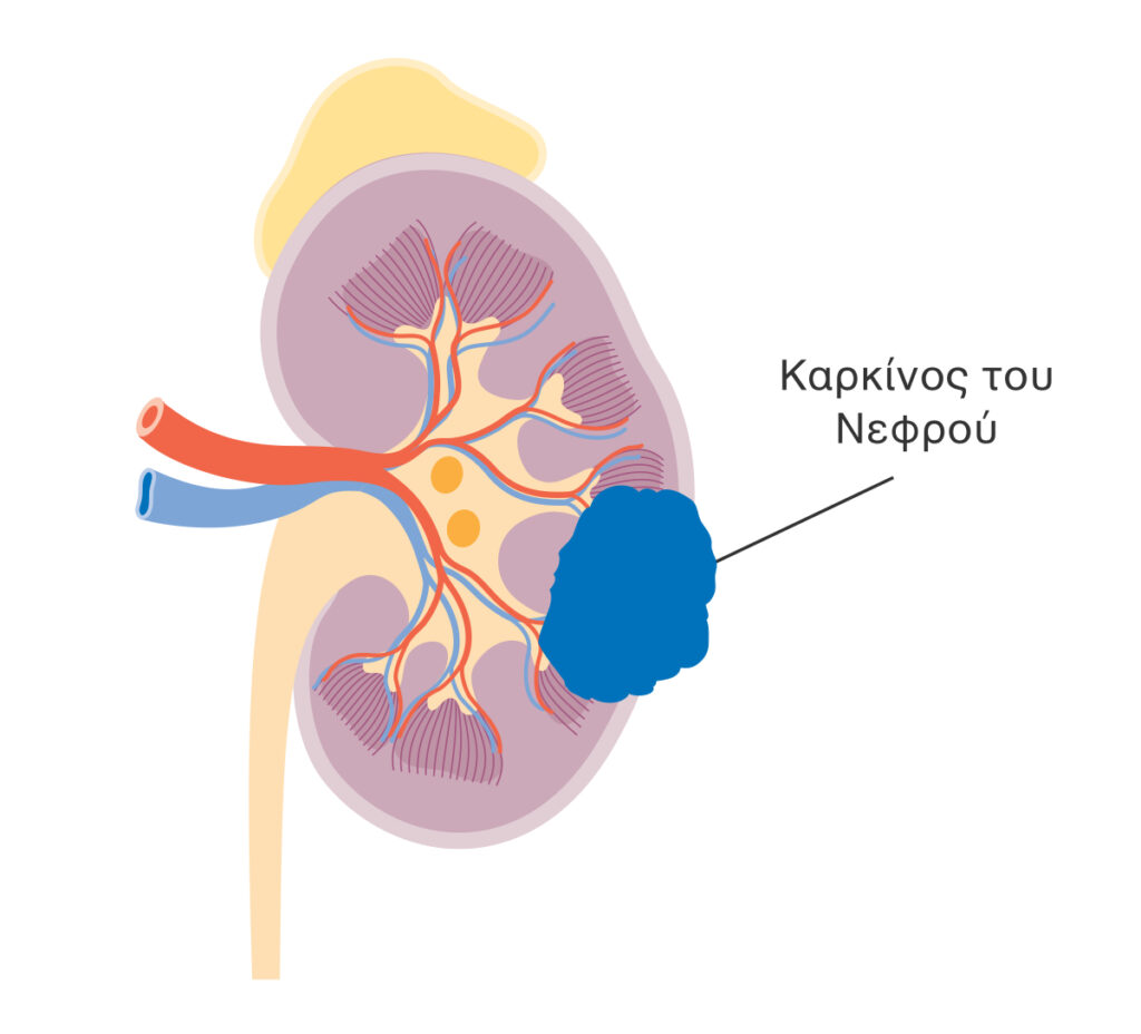 Καρκίνος Νεφρού